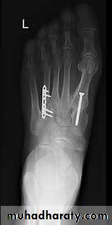 Fracture Talus