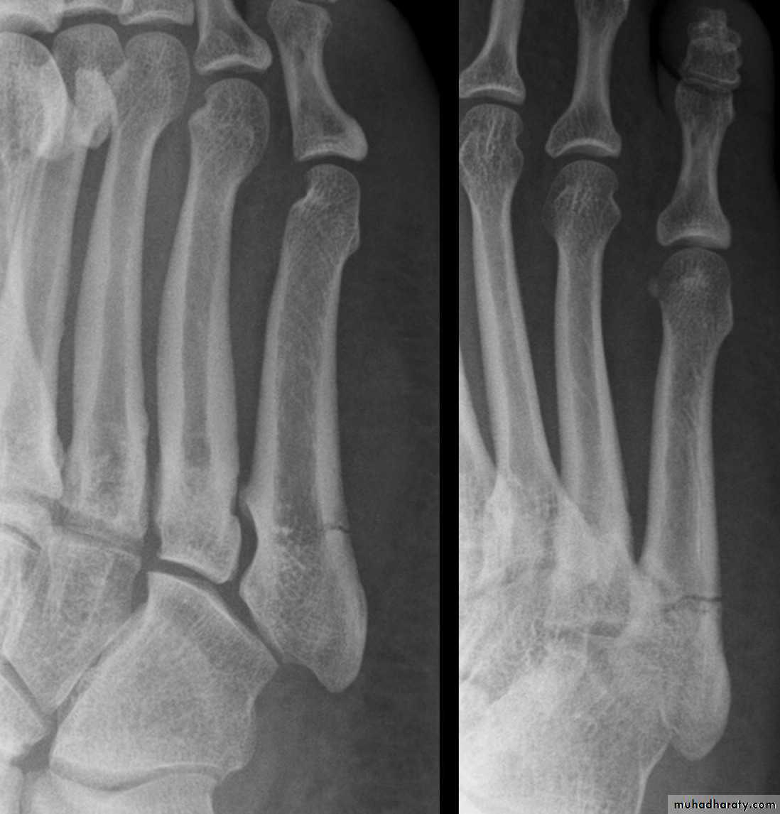 Fracture Talus