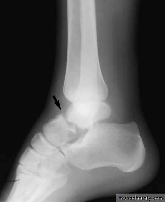 Fracture Talus
