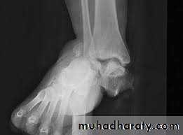 Fracture Talus
