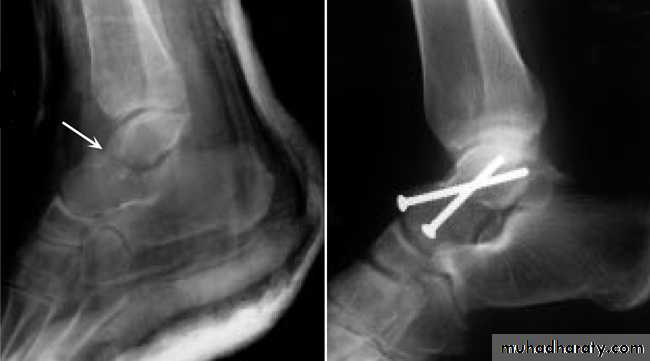 Fracture Talus