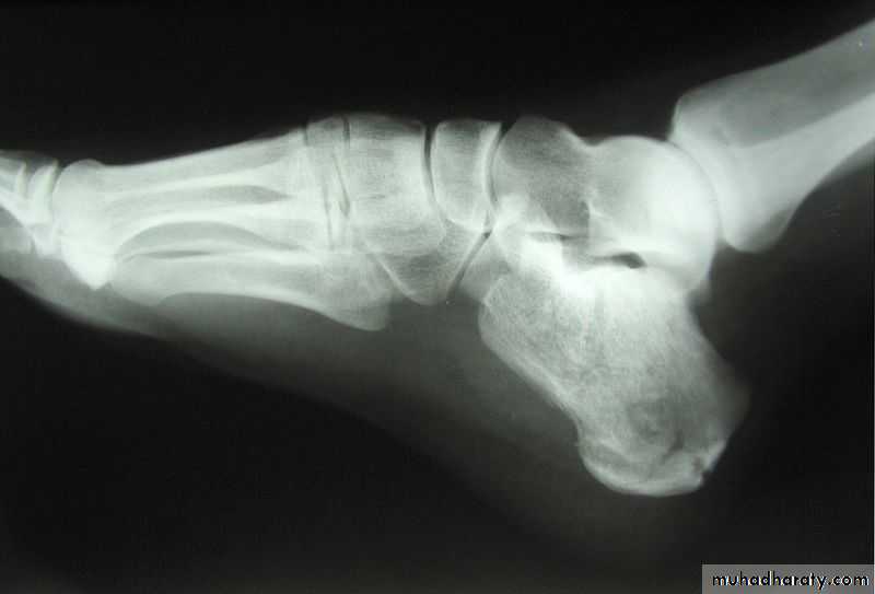 Fracture Talus