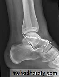 Fracture Talus