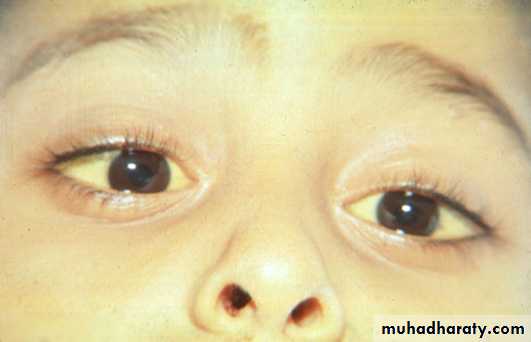 Anemia