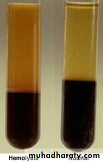 Anemia