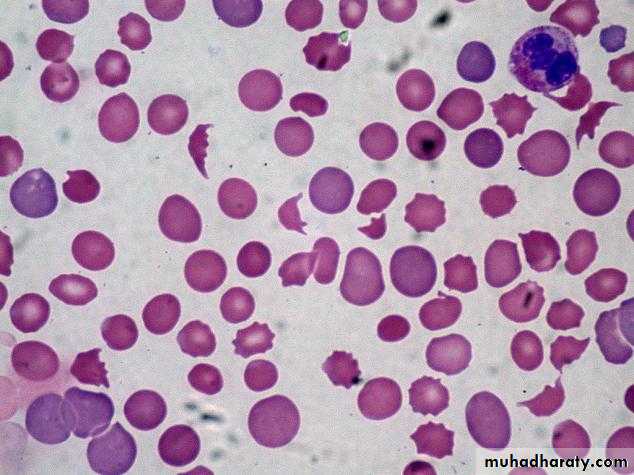 Anemia