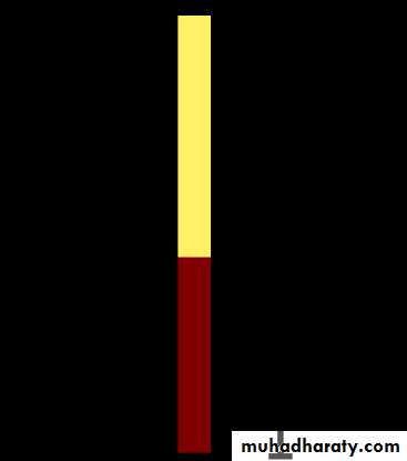 Anemia