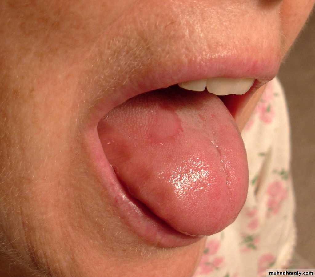 Anemia