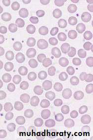 Anemia