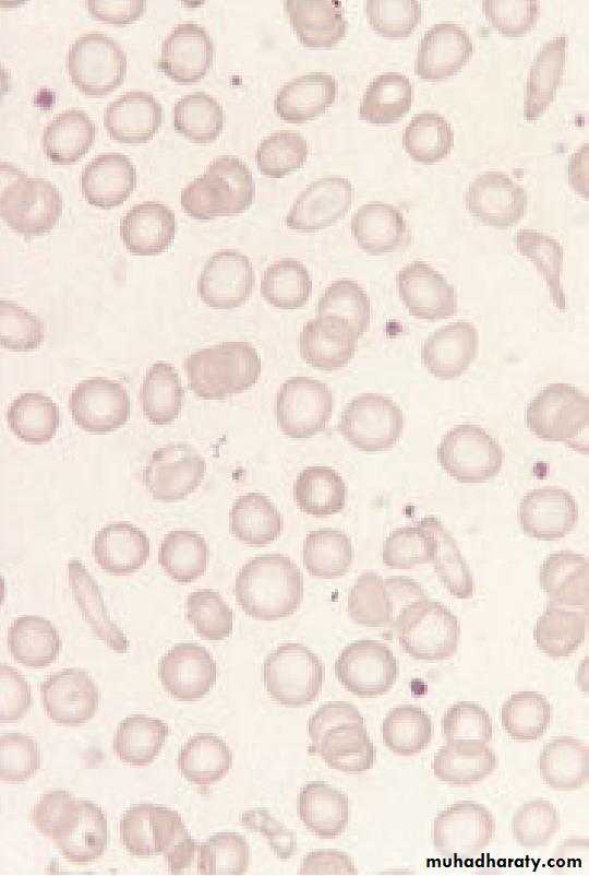 Anemia