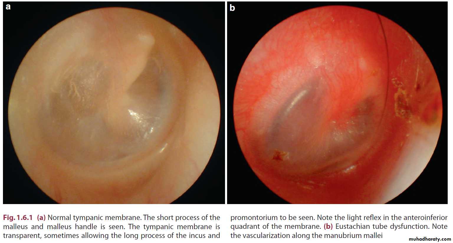 Disease of middle ear
