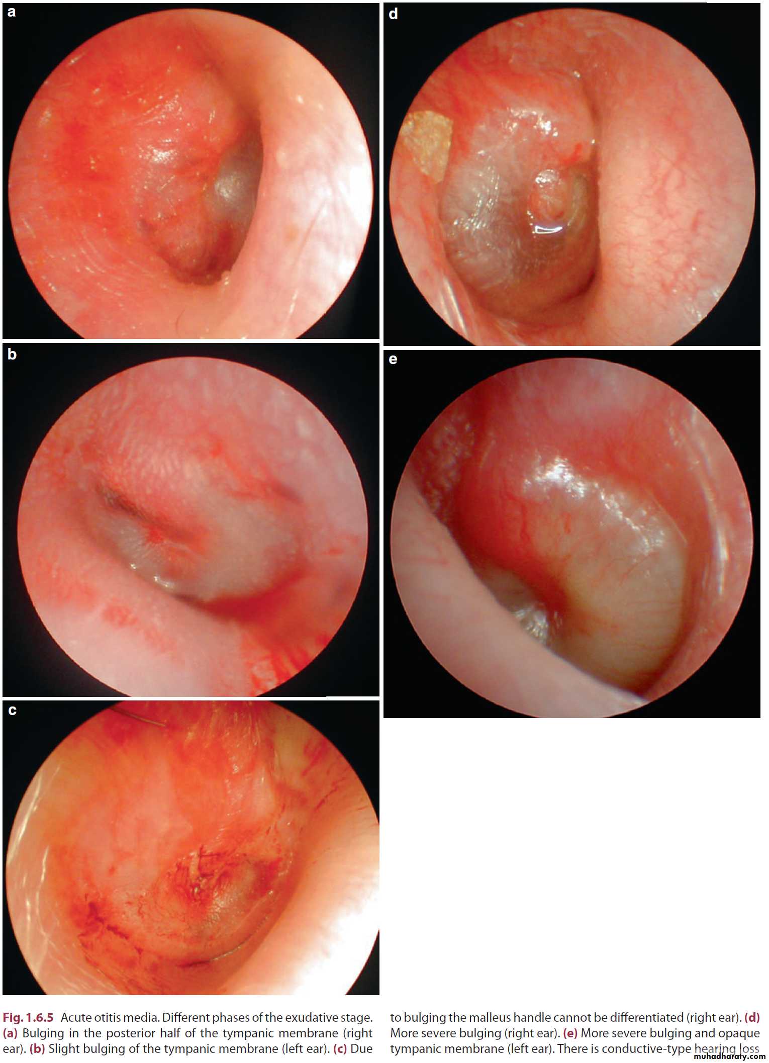 Disease of middle ear