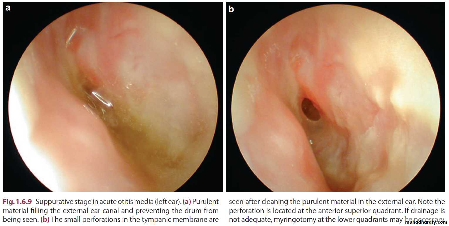 Disease of middle ear