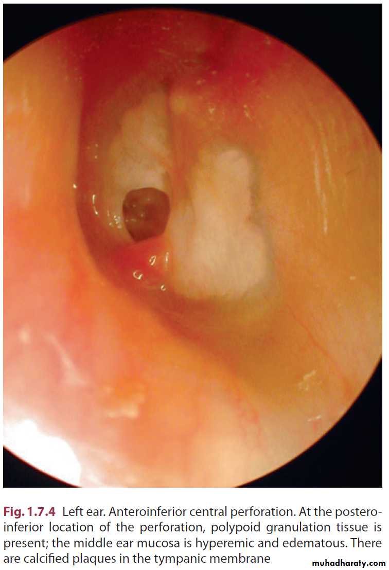 Disease of middle ear
