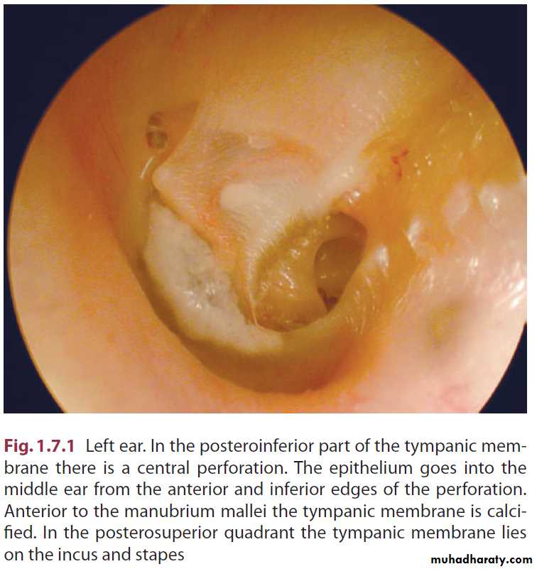 Disease of middle ear