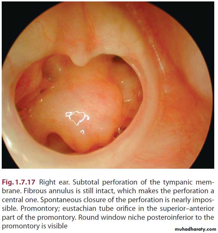 Disease of middle ear