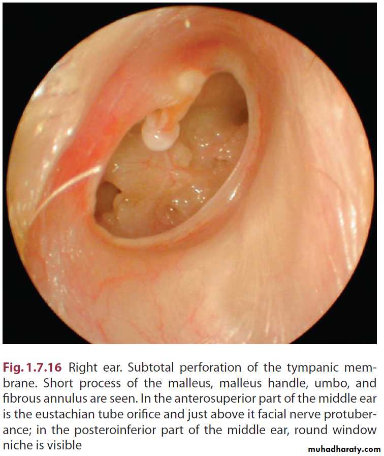Disease of middle ear