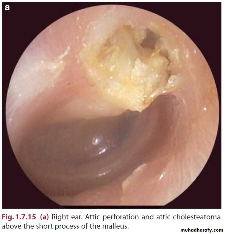 Disease of middle ear
