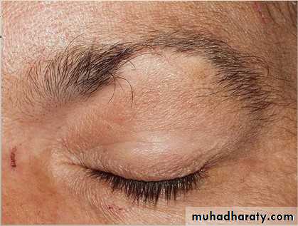hair disorder