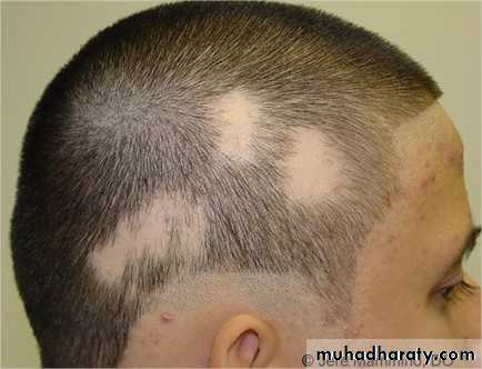 hair disorder