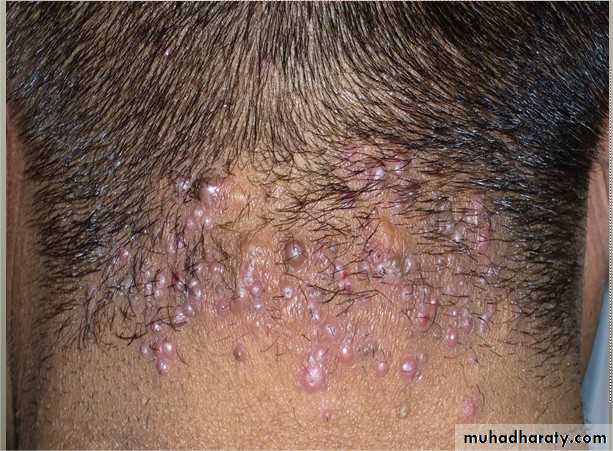 hair disorder