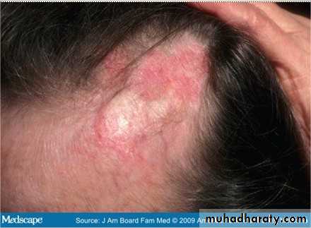 hair disorder