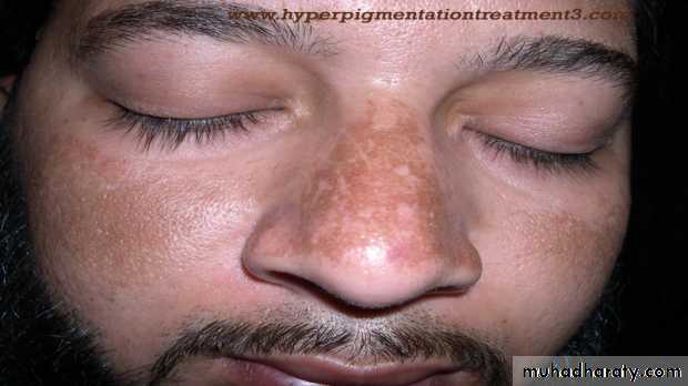 melasma