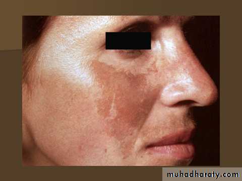 melasma