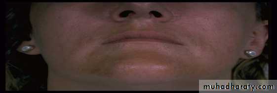 melasma