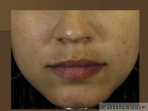 melasma