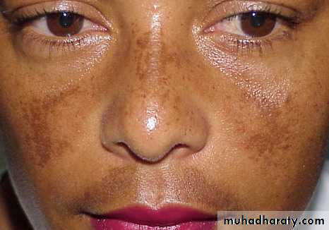 melasma