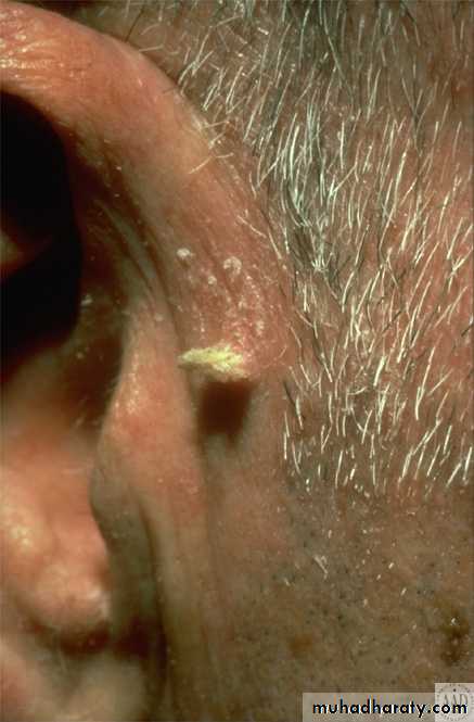 actinic keratosis