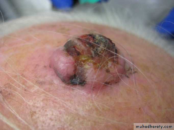 actinic keratosis