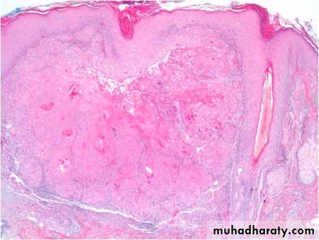 actinic keratosis