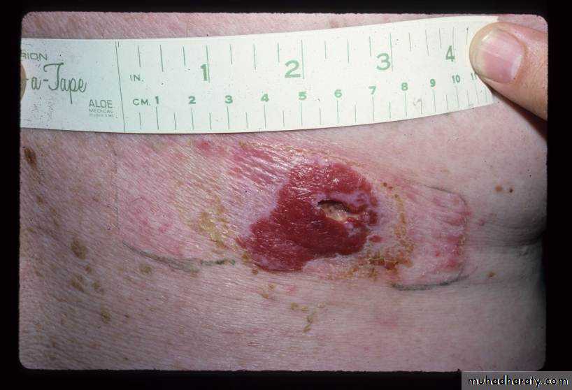 actinic keratosis