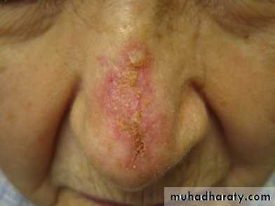 actinic keratosis