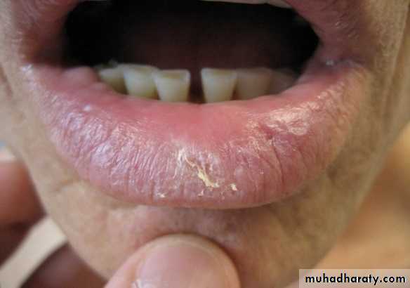 actinic keratosis