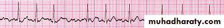 heart failure