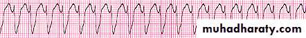 heart failure