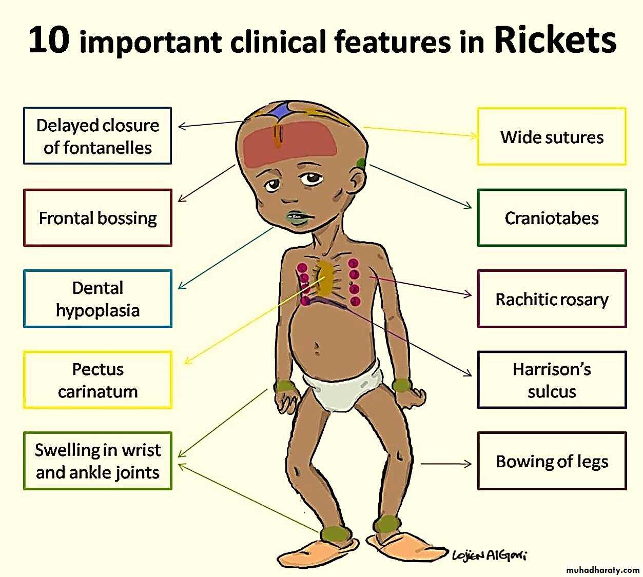 ricket