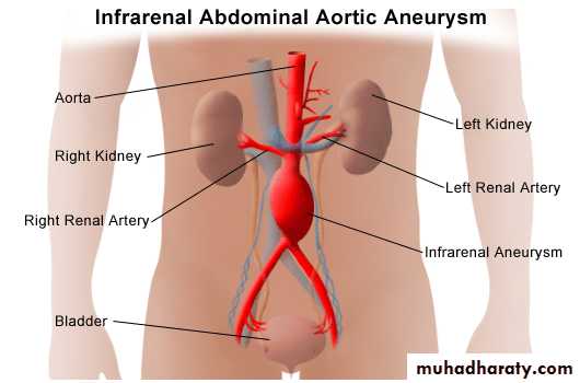 Aneurysm