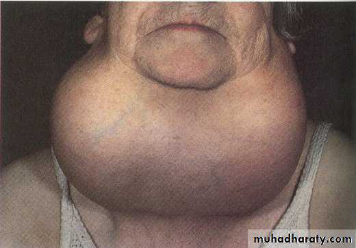 Thyroid disorders