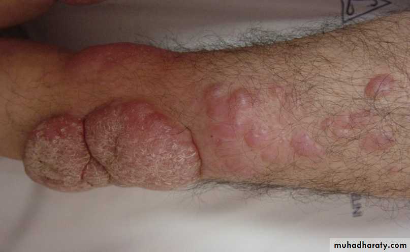 Thyroid disorders