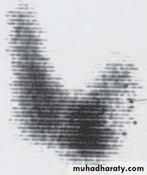 Thyroid disorders