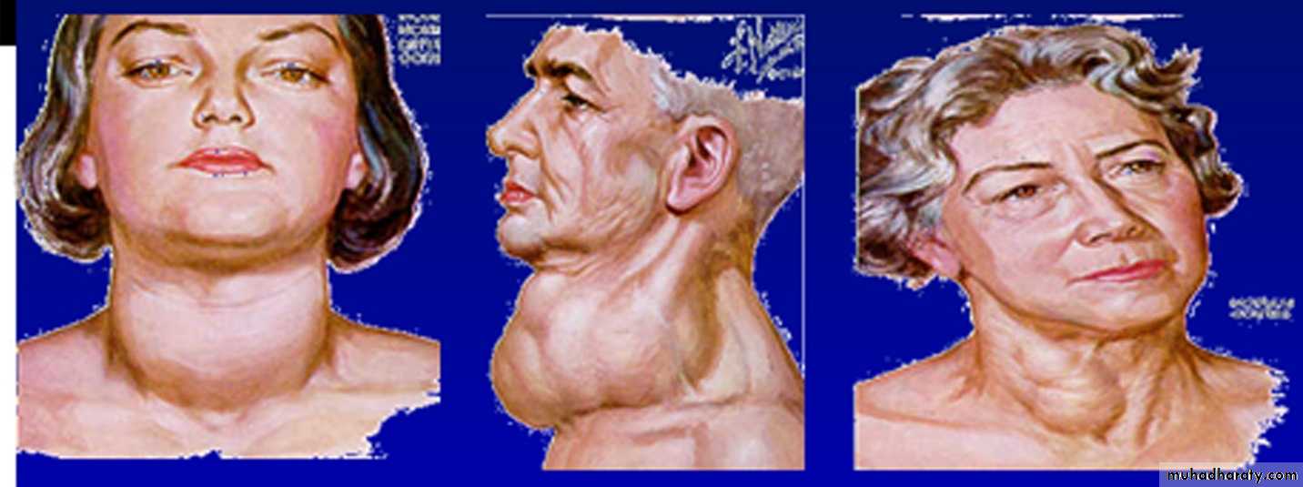 Thyroid disorders