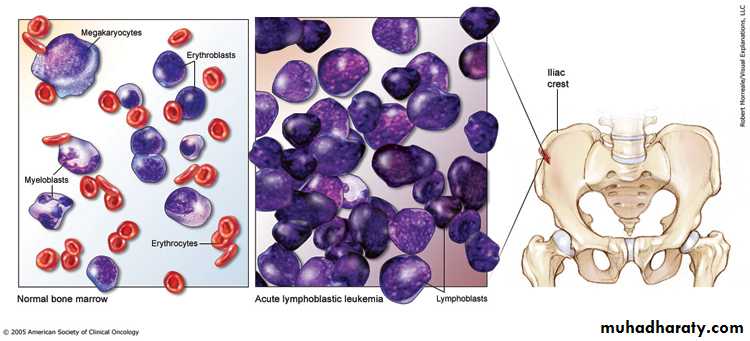 leukemia and lymphoma