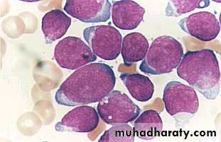 leukemia and lymphoma