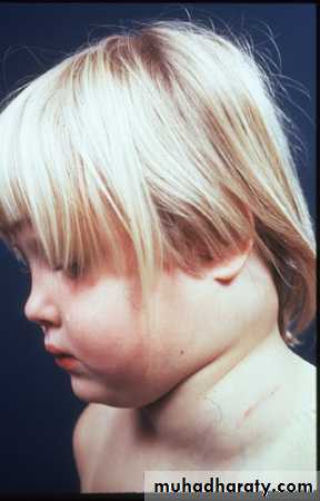 leukemia and lymphoma