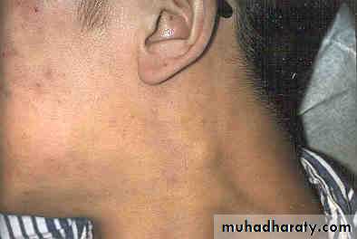 leukemia and lymphoma