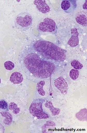 leukemia and lymphoma